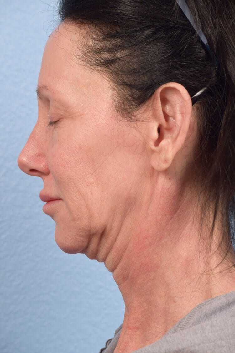 Mini Facelift Before & After Gallery - Patient 303846 - Image 3