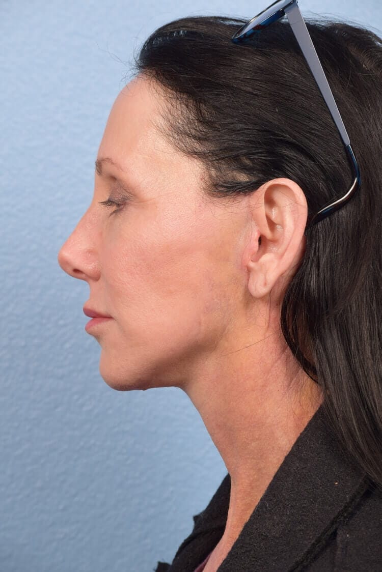 Mini Facelift Before & After Gallery - Patient 303846 - Image 4