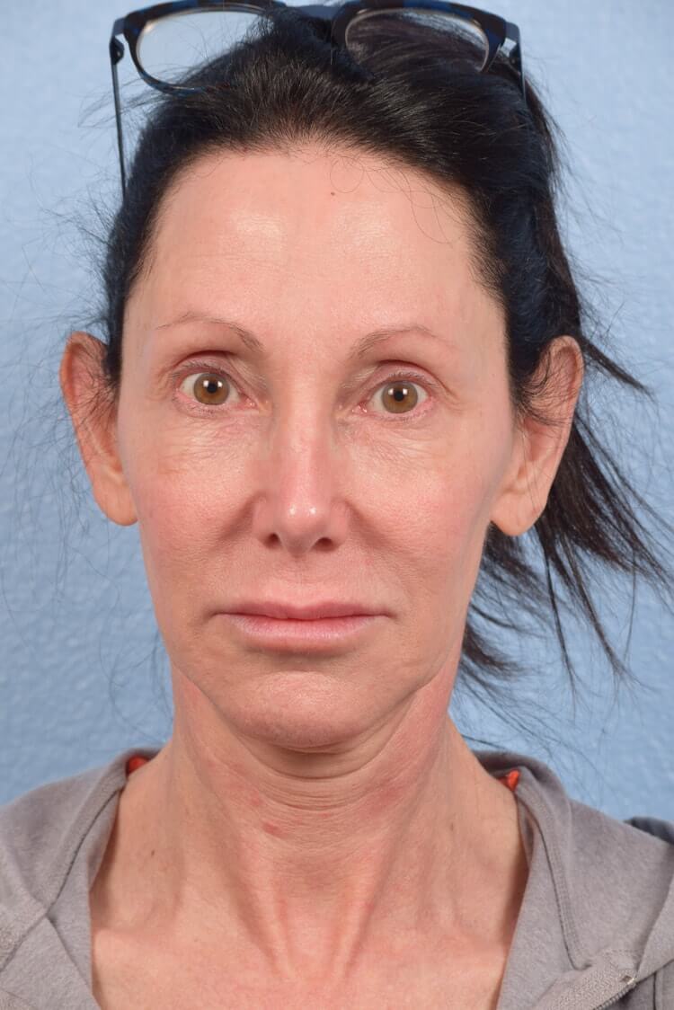 Mini Facelift Before & After Gallery - Patient 303846 - Image 5