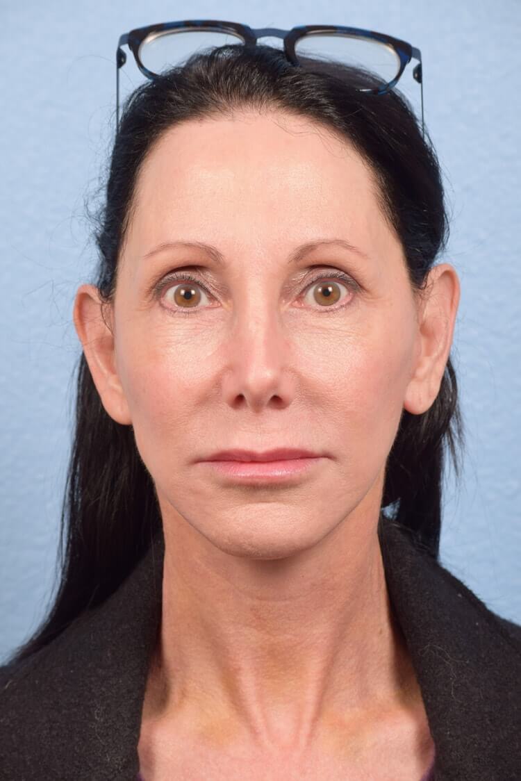 Mini Facelift Before & After Gallery - Patient 303846 - Image 6