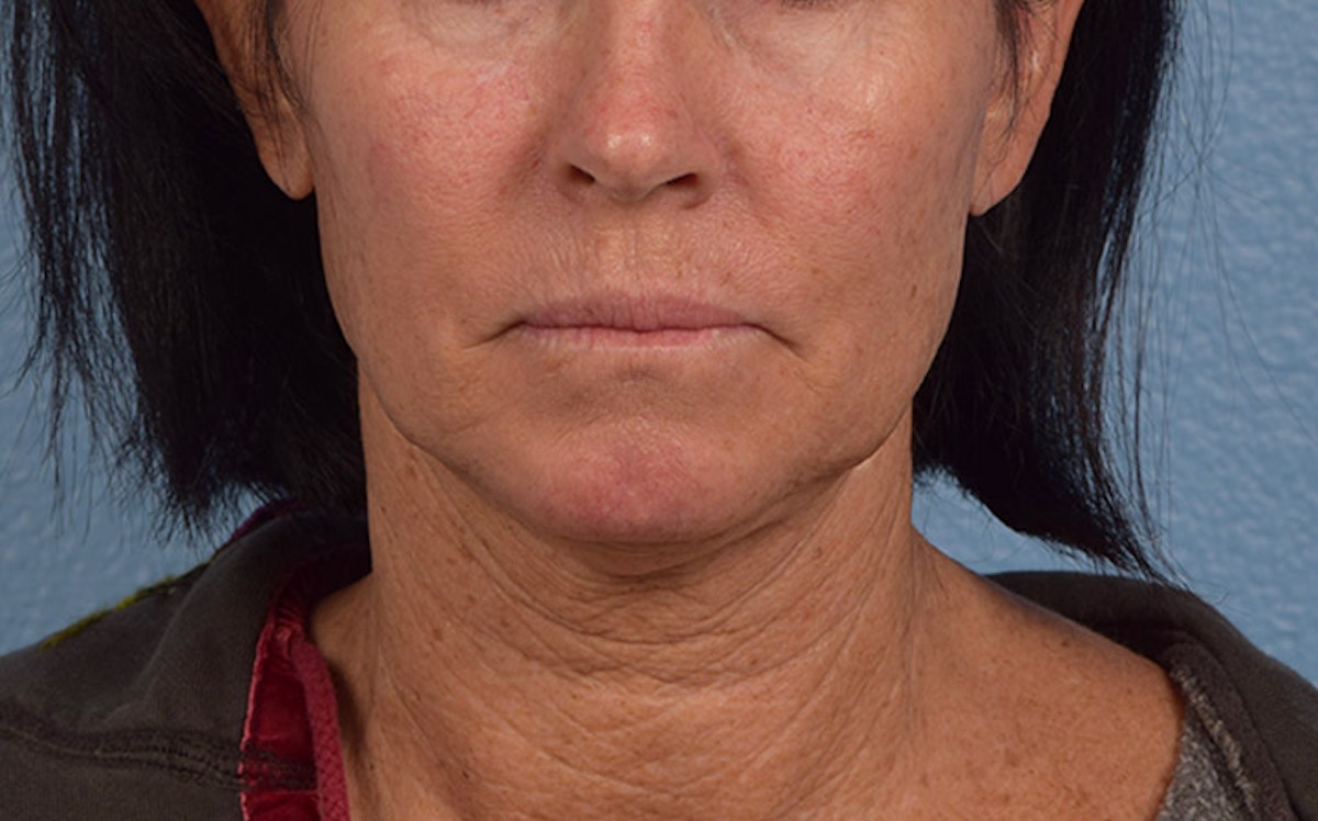 Fat Transfer Before & After Gallery - Patient 512218 - Image 1