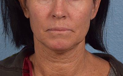 Mini Facelift Before & After Gallery - Patient 301670 - Image 1