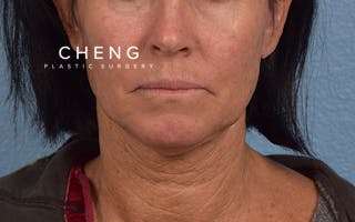 Hidden Patients Before & After Gallery - Patient 372705 - Image 1