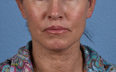 Mini Facelift Before & After Gallery - Patient 301670 - Image 2