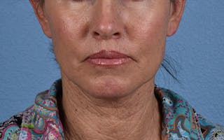 Hidden Patients Before & After Gallery - Patient 372705 - Image 2