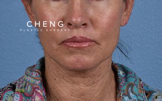 Hidden Patients Before & After Gallery - Patient 372705 - Image 2