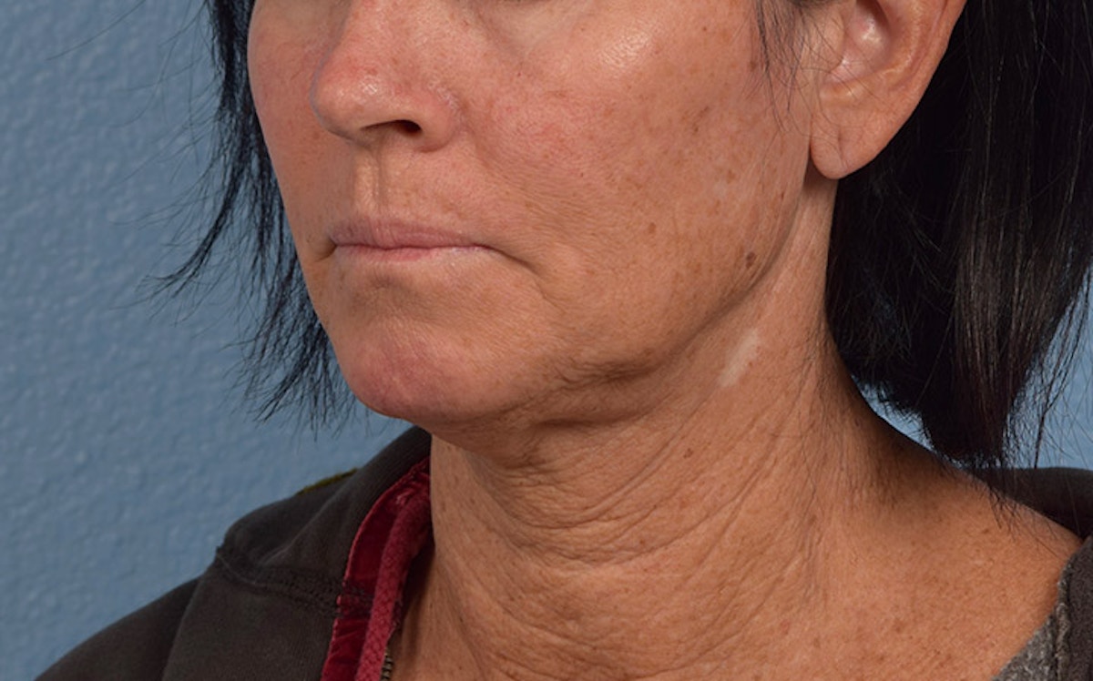 Fat Transfer Before & After Gallery - Patient 512218 - Image 3