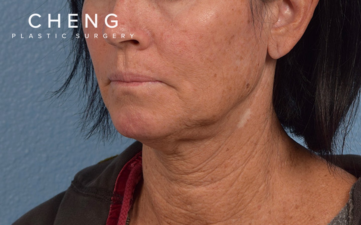 Hidden Patients Before & After Gallery - Patient 372705 - Image 3