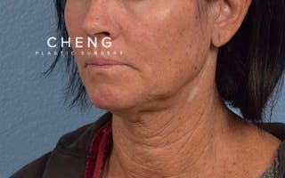 Hidden Patients Before & After Gallery - Patient 372705 - Image 3