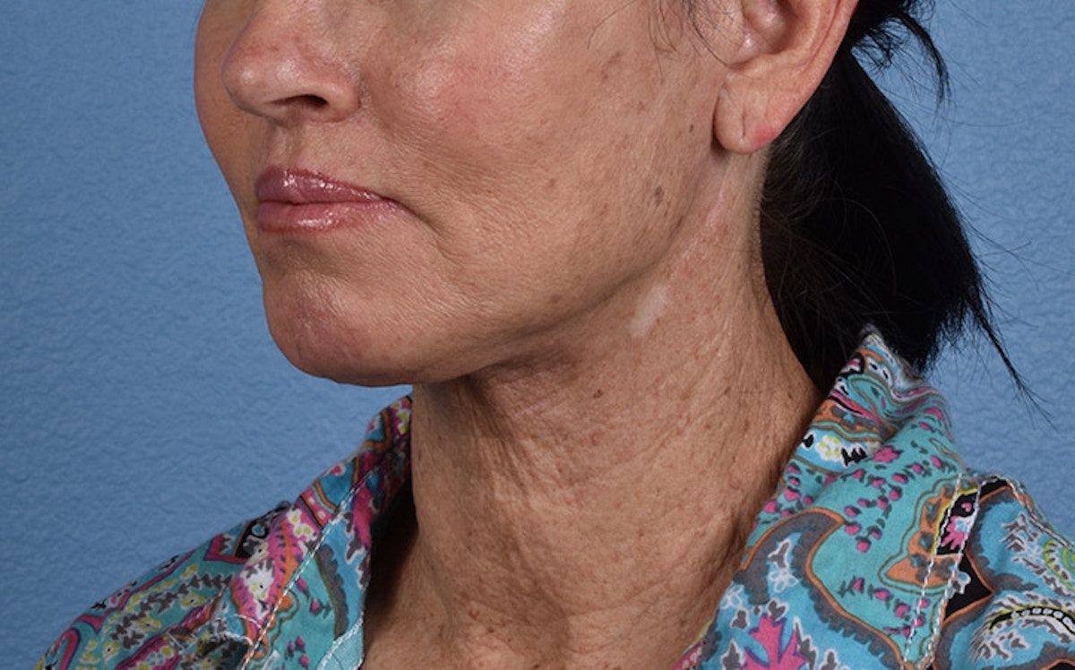 Fat Transfer Before & After Gallery - Patient 512218 - Image 4