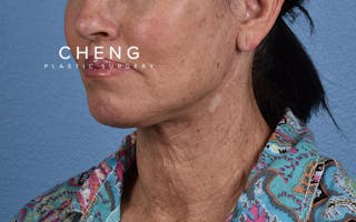 Hidden Patients Before & After Gallery - Patient 372705 - Image 4