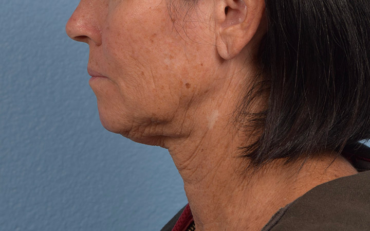 Hidden Patients Before & After Gallery - Patient 357617 - Image 5