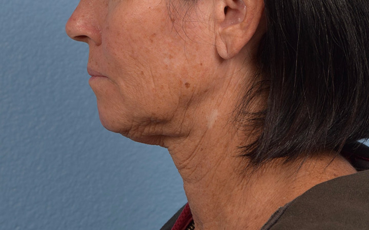 Fat Transfer Before & After Gallery - Patient 512218 - Image 5
