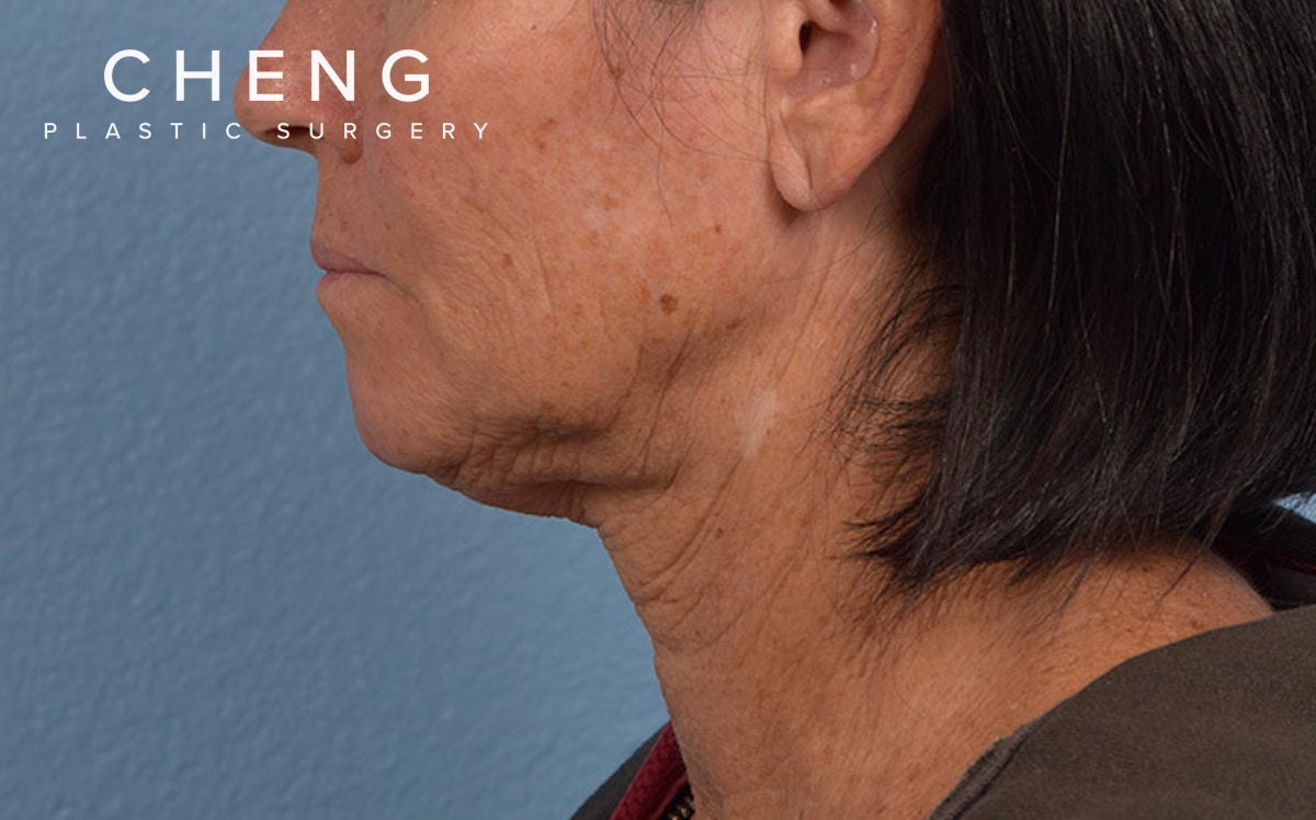 Hidden Patients Before & After Gallery - Patient 372705 - Image 5