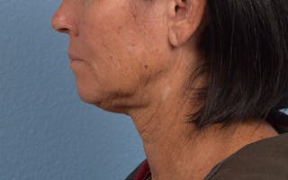 Hidden Patients Before & After Gallery - Patient 372705 - Image 5