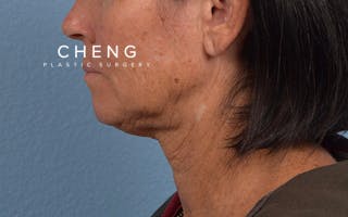 Hidden Patients Before & After Gallery - Patient 372705 - Image 5