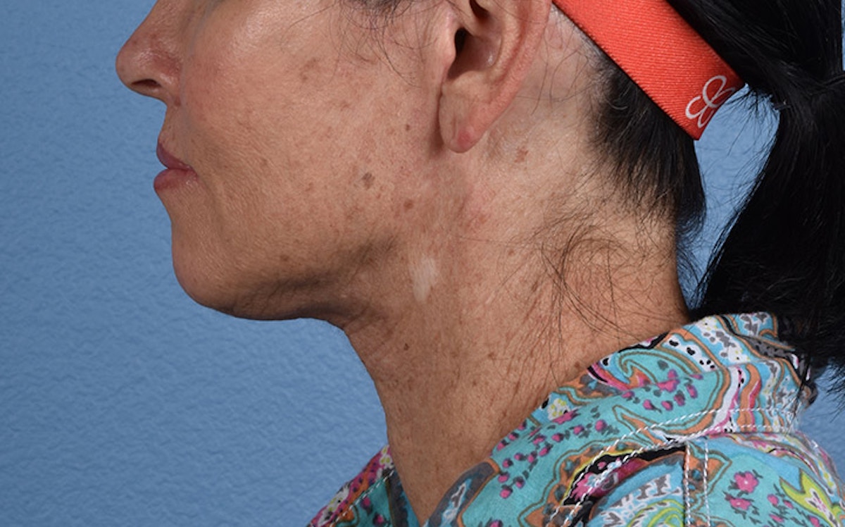 Fat Transfer Before & After Gallery - Patient 512218 - Image 6