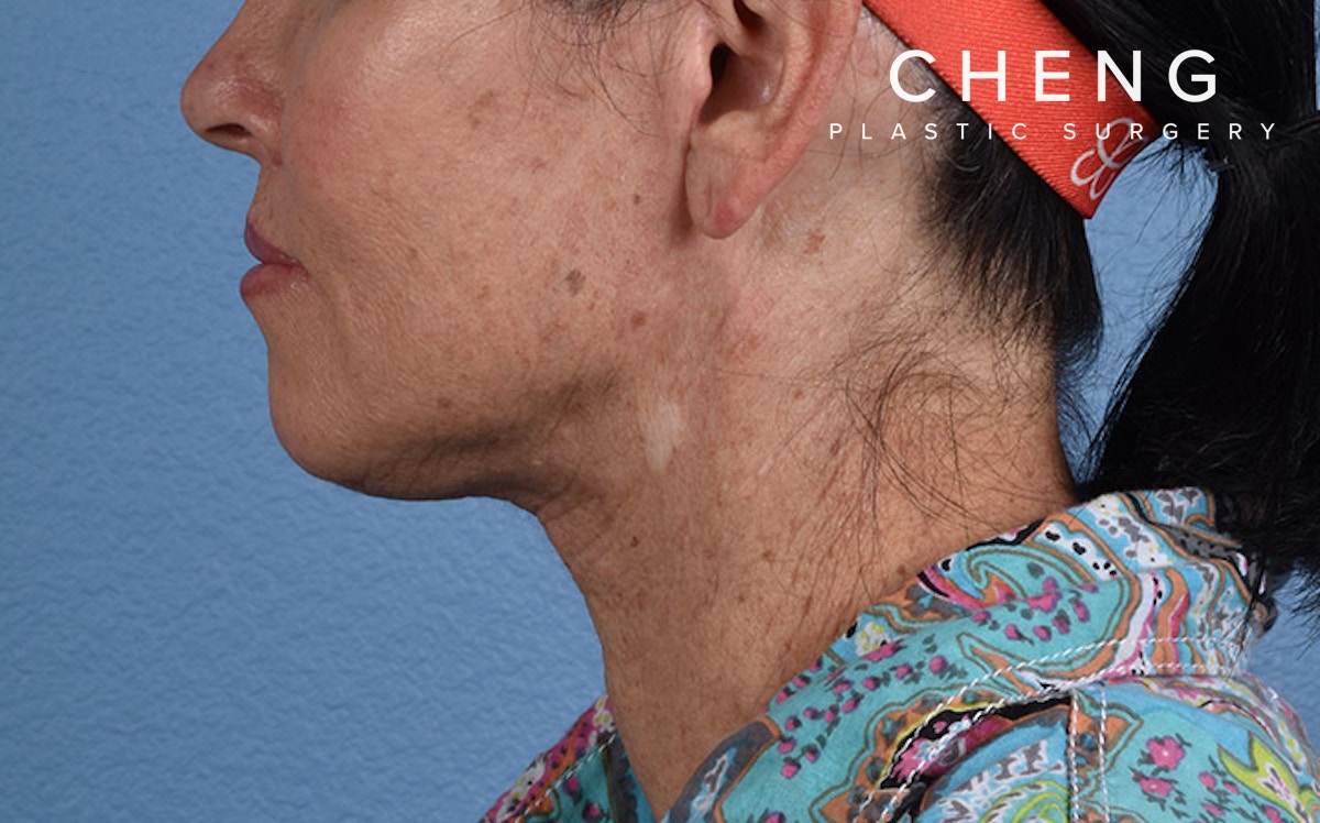 Hidden Patients Before & After Gallery - Patient 372705 - Image 6