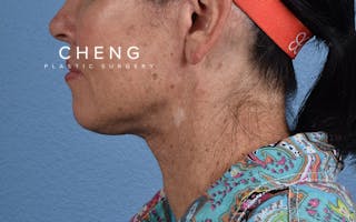 Hidden Patients Before & After Gallery - Patient 372705 - Image 6