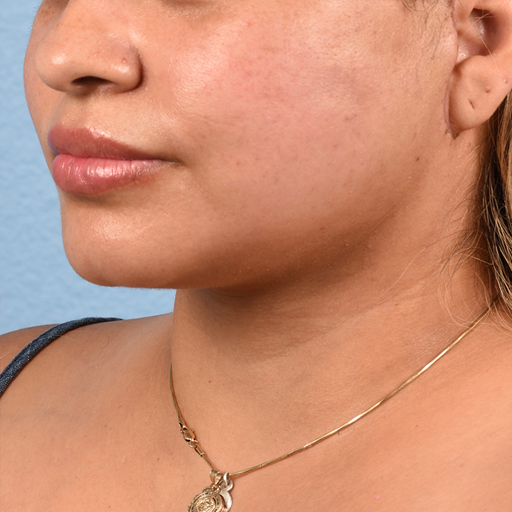Mini Facelift Before & After Gallery - Patient 306934 - Image 4