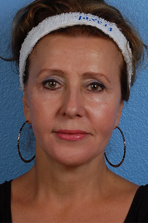 Brow Lift Before & After Gallery - Patient 419519 - Image 2