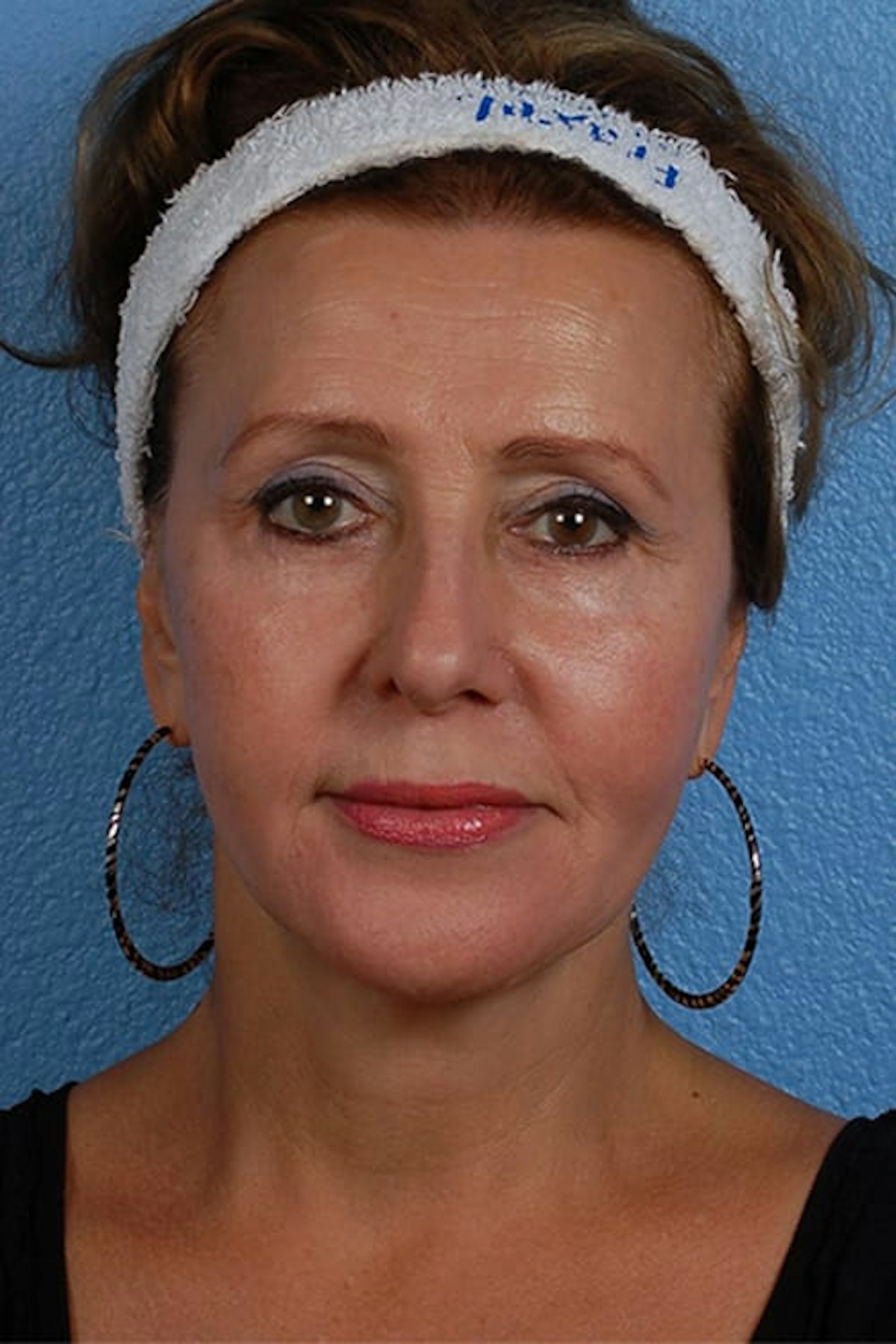 Fat Transfer Before & After Gallery - Patient 333366 - Image 2