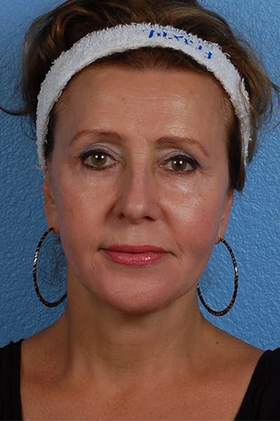 Brow Lift Before & After Gallery - Patient 419519 - Image 2