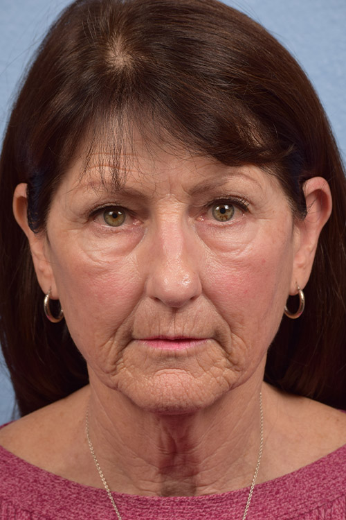 Chemical Peel Before & After Gallery - Patient 173948 - Image 1