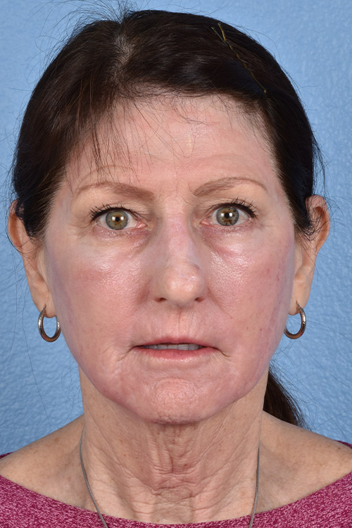 Chemical Peel Before & After Gallery - Patient 173948 - Image 2