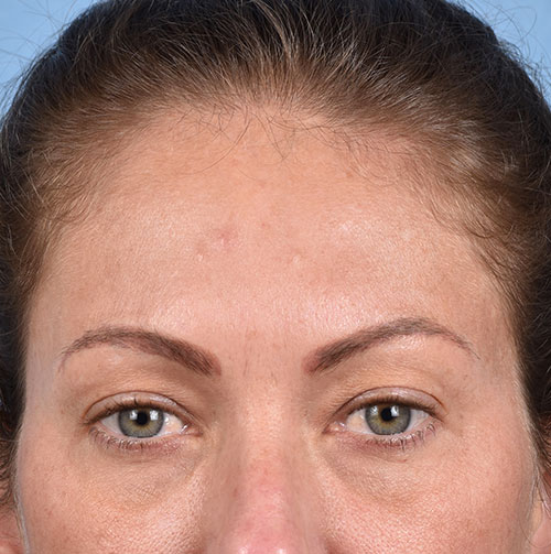 Blepharoplasty Before & After Gallery - Patient 213842 - Image 3