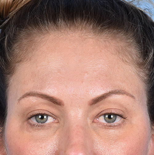 Blepharoplasty Before & After Gallery - Patient 213842 - Image 4