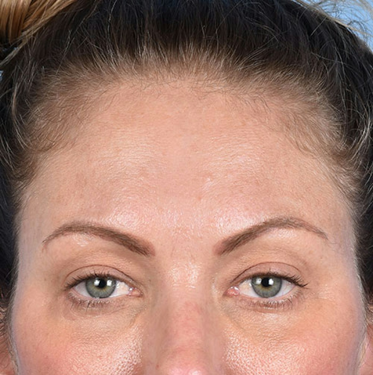 Fat Transfer Before & After Gallery - Patient 263177 - Image 2