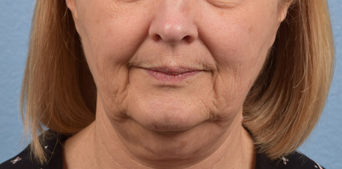 Fat Transfer Before & After Gallery - Patient 147770 - Image 1
