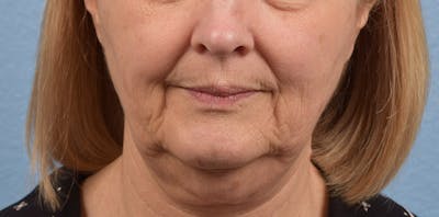 Fat Transfer Before & After Gallery - Patient 147770 - Image 1