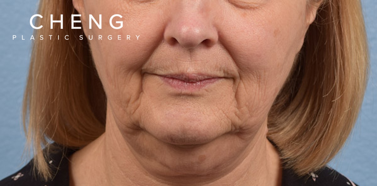 Hidden Patients Before & After Gallery - Patient 186097 - Image 1