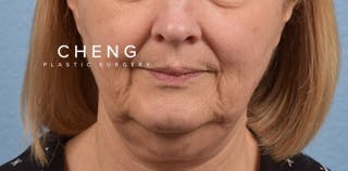 Hidden Patients Before & After Gallery - Patient 186097 - Image 1