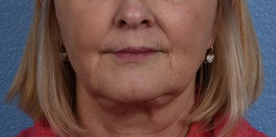 Fat Transfer Before & After Gallery - Patient 147770 - Image 2