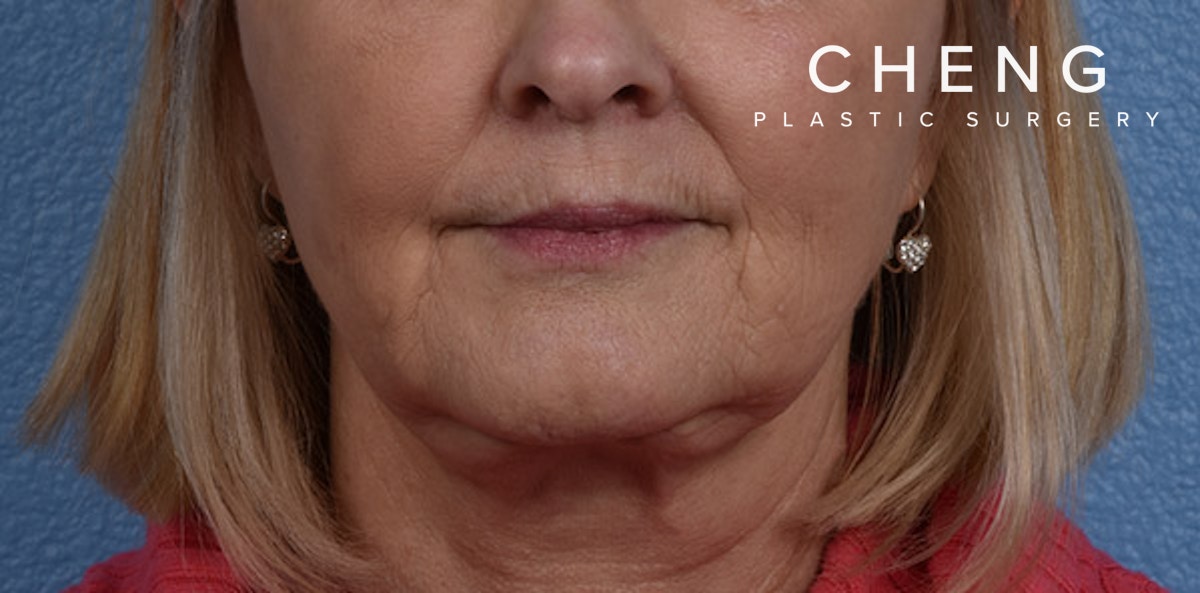 Hidden Patients Before & After Gallery - Patient 186097 - Image 2