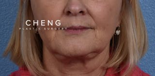 Hidden Patients Before & After Gallery - Patient 186097 - Image 2