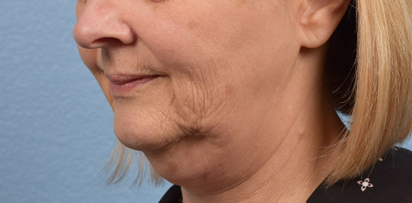 Hidden Patients Before & After Gallery - Patient 186097 - Image 3