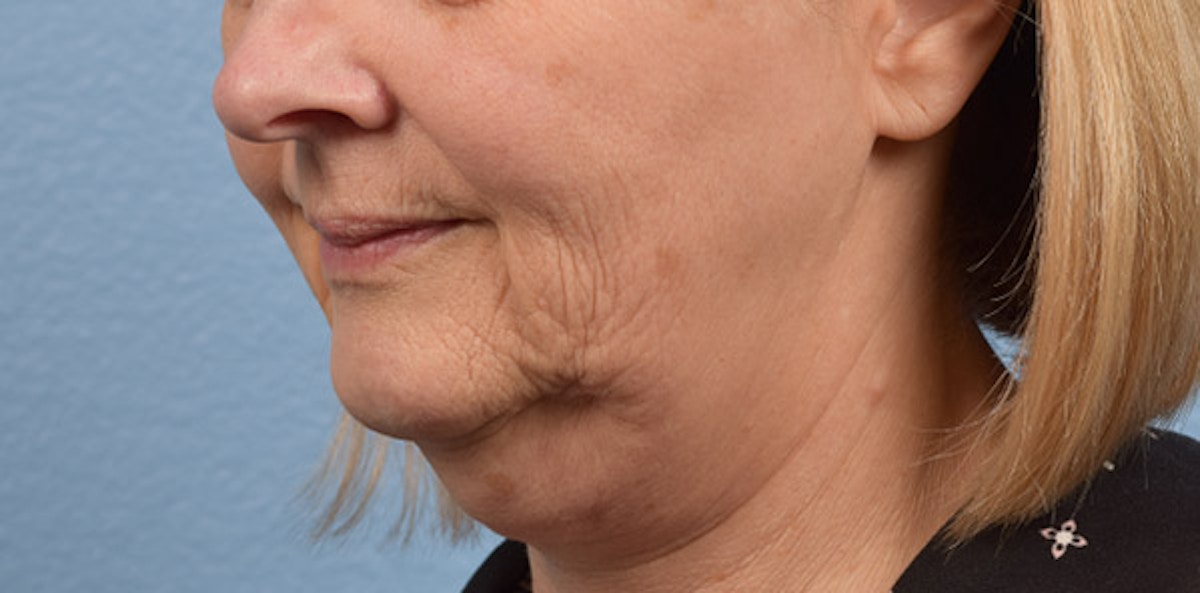 Fat Transfer Before & After Gallery - Patient 147770 - Image 3