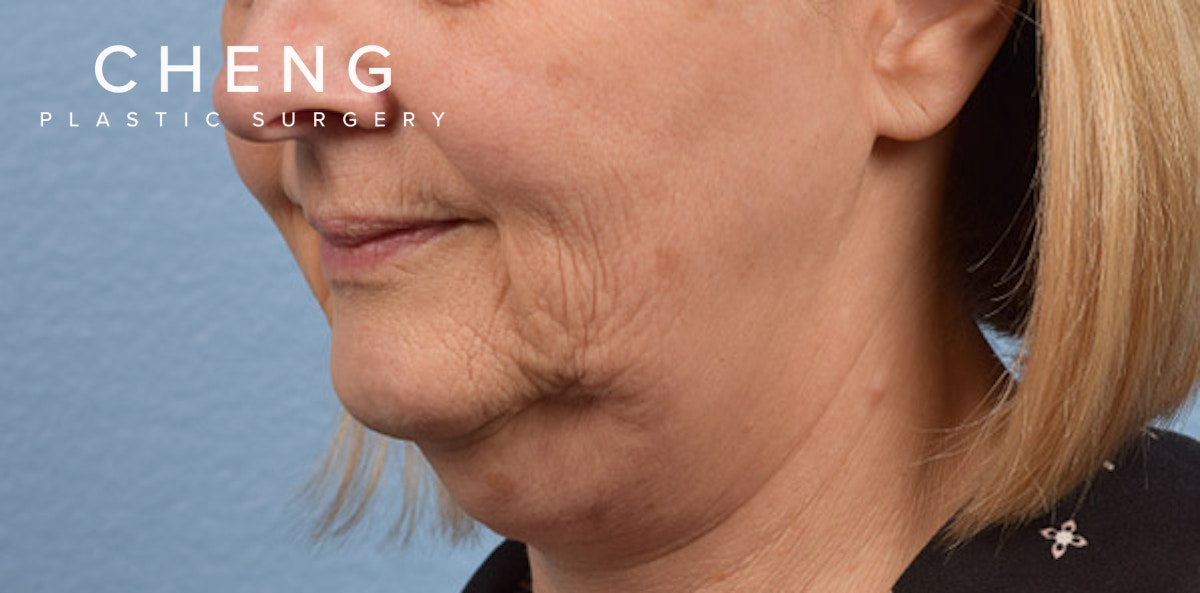 Hidden Patients Before & After Gallery - Patient 186097 - Image 3