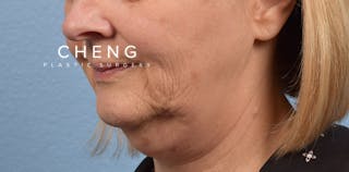 Hidden Patients Before & After Gallery - Patient 186097 - Image 3