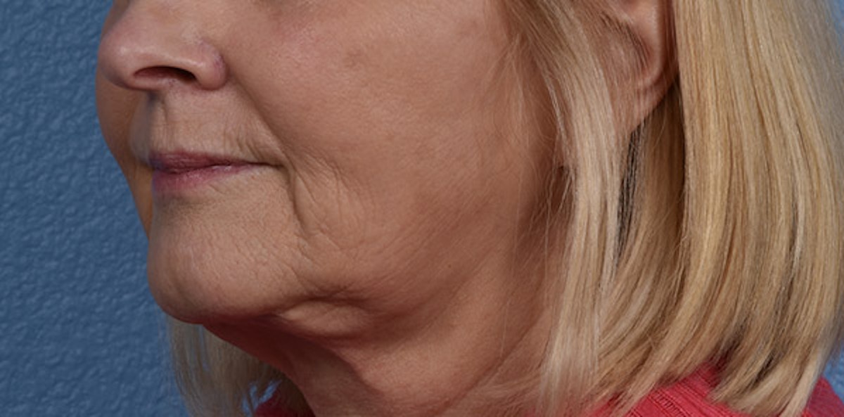 Fat Transfer Before & After Gallery - Patient 147770 - Image 4