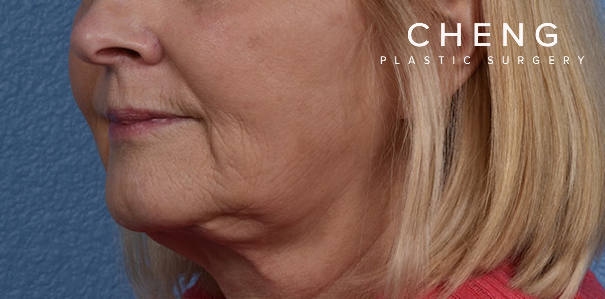 Hidden Patients Before & After Gallery - Patient 186097 - Image 4