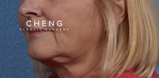 Hidden Patients Before & After Gallery - Patient 186097 - Image 4