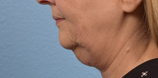 Hidden Patients Before & After Gallery - Patient 186097 - Image 5