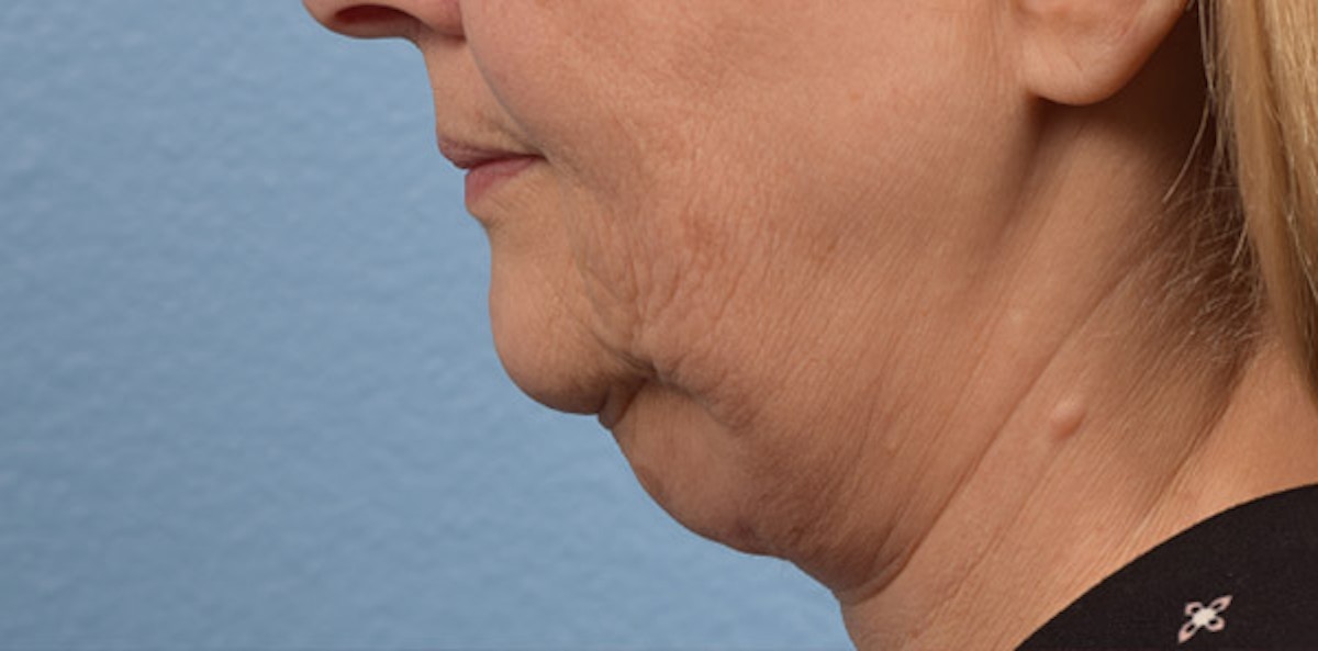 Fat Transfer Before & After Gallery - Patient 147770 - Image 5