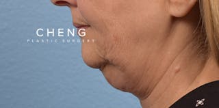 Hidden Patients Before & After Gallery - Patient 186097 - Image 5