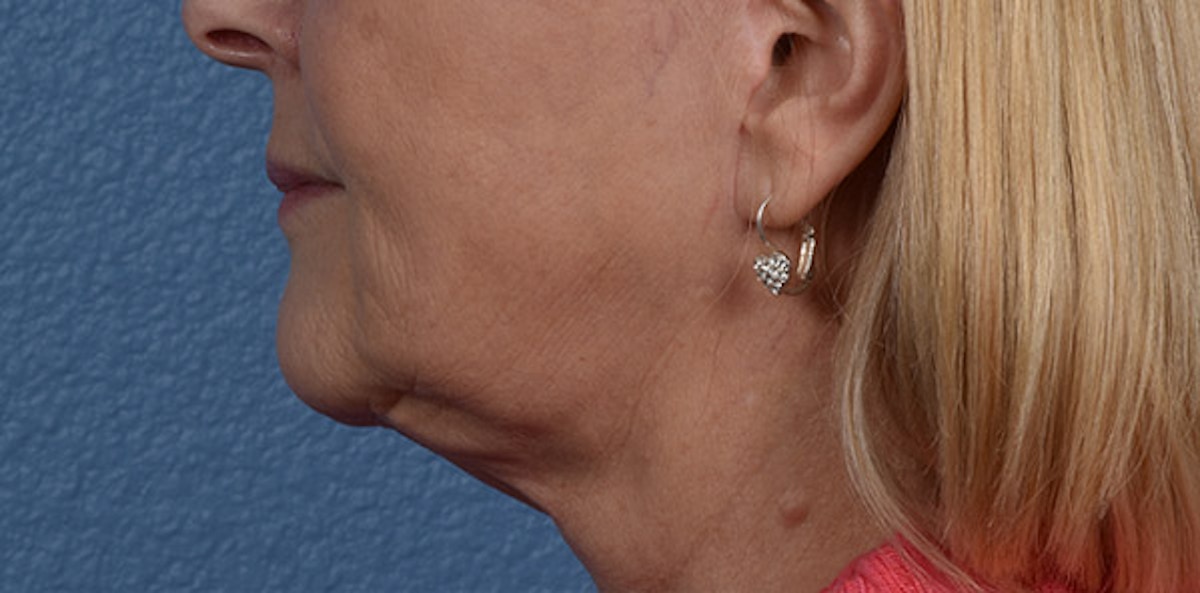 Fat Transfer Before & After Gallery - Patient 147770 - Image 6